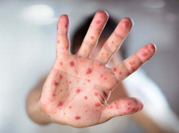 منظمة الصحة العالمية تستدعي لجنة الطوارئ