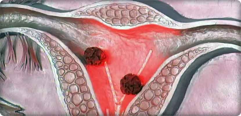 ملف كامل عن سرطان بطانة الرحم، الأعراض والأسباب، والوقاية والعلاج