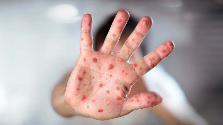 منظمة الصحة العالمية تستدعي لجنة الطوارئ
