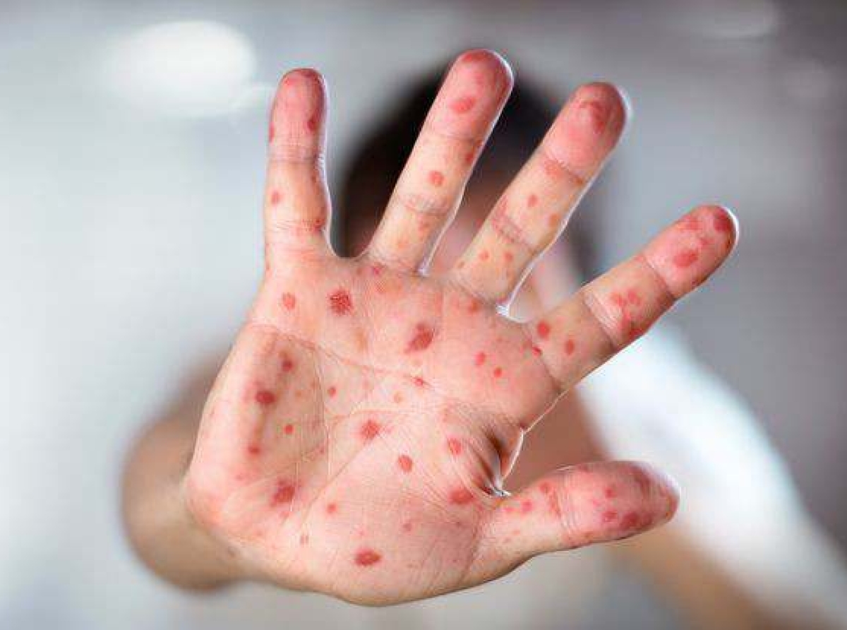 منظمة الصحة العالمية تستدعي لجنة الطوارئ